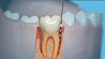 Periodontal Surgery